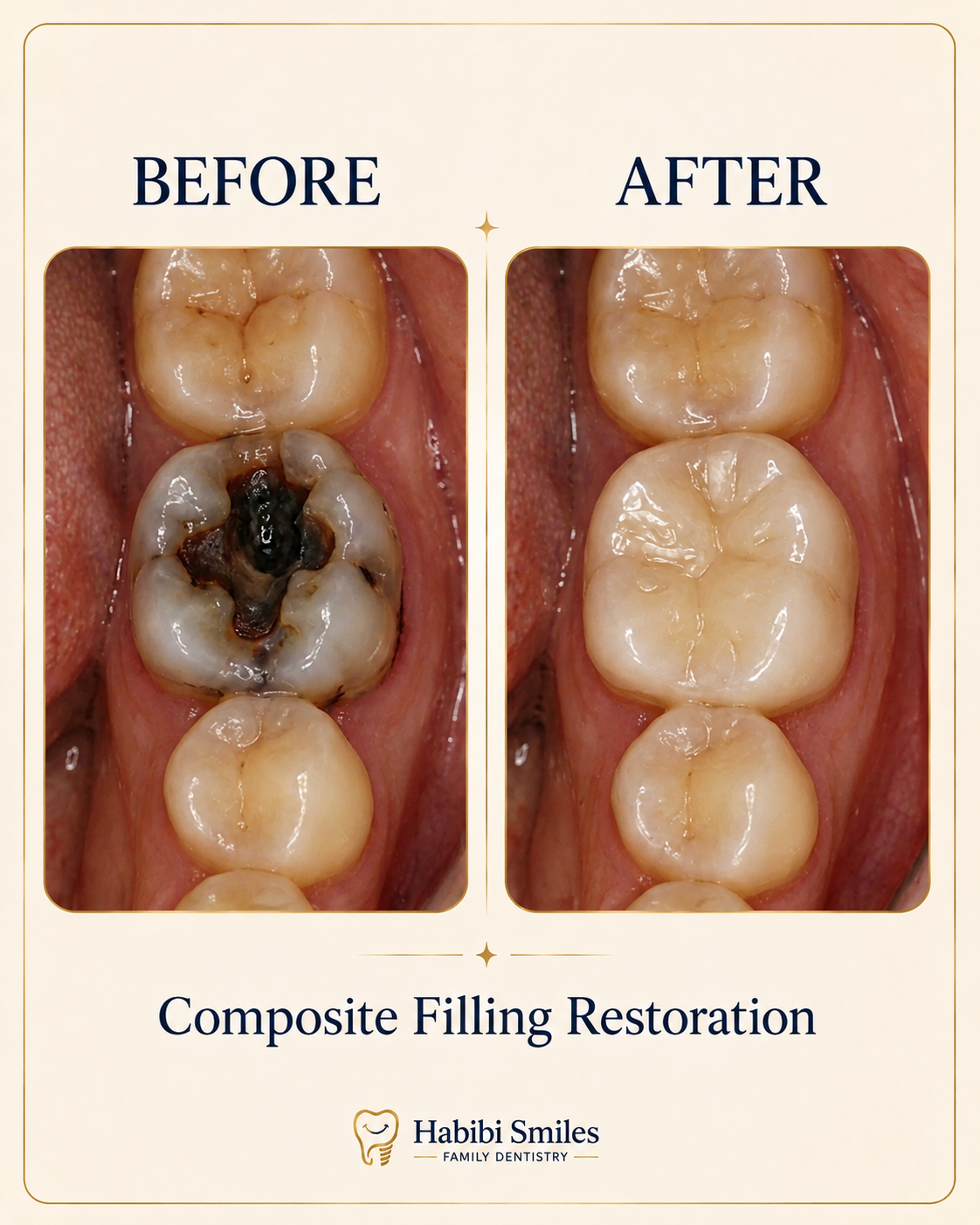 Composite Filling Restoration