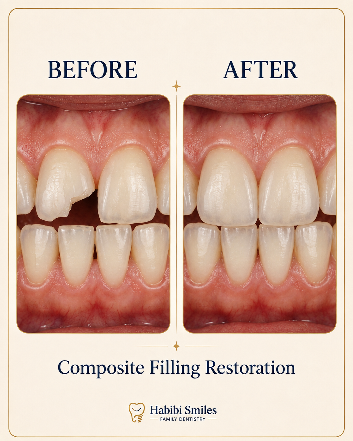 Cosmetic Bonding Restoration
